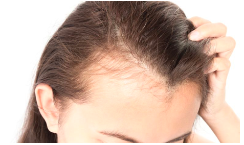 Απώλεια μαλλιών και κανναβιδιόλη (CBD)  Τι πρέπει να προσέξετε